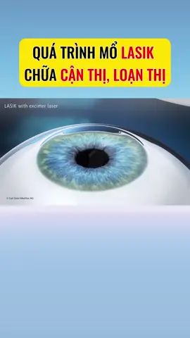Mổ Lasik điều trị cận thị, loạn thị, viễn thị #mocanthi #canthi #loanthi #tatkhucxa #lasik #xoacan #chamsocmat #minhnhankhang #xuhuongtiktok 