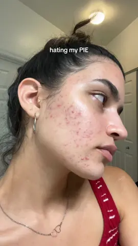 11 months of progress 😌 how’d i do it? Focusing as much as possible on a low glycemic, low dairy lifestyle and using gentle skincare products. The biggest boost in my progress came from trying out the Skin Accumax supplements from Jane Iredale. No dermatologist involved 🫣 #acne #acneprogress #acneconfidence #acnepositivity #postinflammatoryerythema #strawberryfreckles #holistichealth 