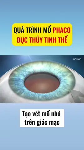 Quá trình mổ phaco đục thuỷ tinh thể #ducthuytinhthe #phauthuatphaco #mophaco #thaythuytinhthe #chamsocmat #cataract #phacosurgery #minhnhankhang #xuhuong 