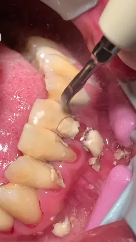🦷🪥😱 #dentista #dentist #dentistryworld #scaling #tartaro #dentalcalculus #tartaros_team 