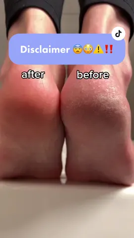 a summer must-have to get soft feet at home! 😍 #footcare #fypp #viral #londonuk🇬🇧 #footfile #softfeettips #athomepedicure 