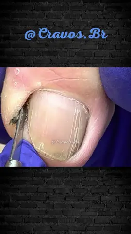 Tratamento 221 - #blackhead #cravoseespinhas #unha #tratamento #acne #cravos #tiktok #foryou 
