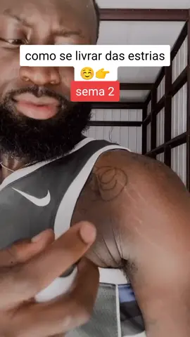 #paravocê #estrias #dicasdeestrias #mulher#pelemaisjovem #dicasdebelza 