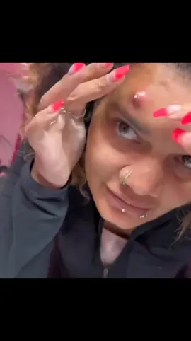 #dr_pimple_popper_top❤️ #blackdots #pimples #acne #brufoli #foryou #popping #fyp #pimplepop #face #pimple #blakhead #nose #satisfying #pimpleremover #blackheadsremoval #pimplepopper #puntosnegros #pimplepopperaddict #bigpimple