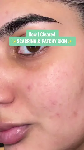 Best way to fade scarring, uneven and patchy skin✨#foryoupage #foryou #trending #skin #skincare #clearskin #acne #acneskin #asiangirl #desi 