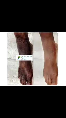 Sqt herbal  is banger🔥🔥🔥🔥 Result is waooo for leg burn removal Baddest transformation  SQT Spongila herbal peel is the rescue  Have you tried the newest revolutionary treatment to hit the Nigeria?…. 💌Book NOW!  👉Sets available only in @honeyglowbeautyworld_nd_spa ❗❗❗ Contact ☎ Honeyglow Tel/Whatsapp: +2347033970985 🇳🇬🇳🇬🇳🇬🇳🇬🇳🇬🇳🇬🇳🇬🇳🇬🇳🇬🇳🇬🇳🇬🇳🇬🇳🇬🇳🇬🇳🇬#glownation#fyp #viraltiktok #trending #viral #skincareroutine #honeyglow #sqt #spa 