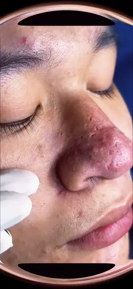 Blackheads and Whiteheads removal ✅🧤 #blackhead #pimples #blackheads #blackheadextraction #whiteheadsremoval #pimple #blackheadsremoval #satisfaction #pimplepop #fyps #satisfying #satisfyingvideo #pimplepatches #removal #satysfying #peeling #extractions #squeeze #earwax #ohmygod 