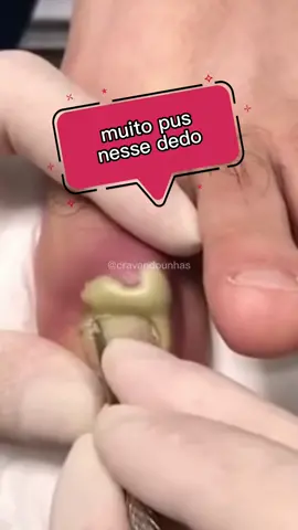 Muito pus nesse dedo meu Deus 😱😱 #unhasencravadas #desencravandounhas #unhacompus #ingrowntoenail #ingrowntoenailremoval 