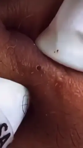 #fyyyyyyyyyyyyyyyy #satisfatorio #viral #pimple #asmr #fly #espremerespinha #espinhas 
