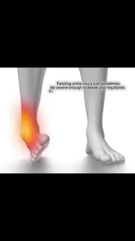 Patient presented to the emergency department after twisting their ankle. Both ankle malleoli were fractured. Surgery was done the next day after medical clearance for surgery and was discharged 48 hours later 💪🏼
