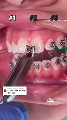 Replying to @notlydss how painful are braces!? 😭 #braces #bracestips #bracesoff #fyp #viral #food #candy #bracescolors #transformation #sour 