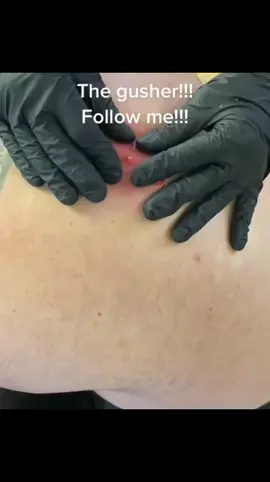 #dr_pimple_popper_top❤️