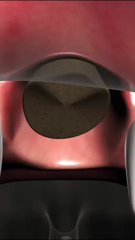 Dental Implant Simulation #fyp #teeth #dentist #cleaning #implant