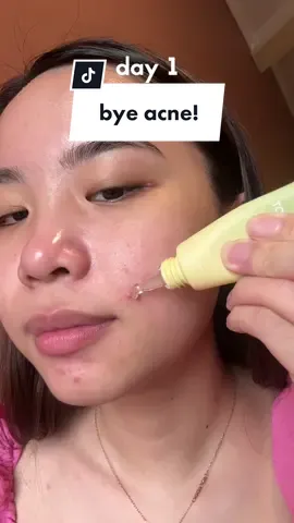 jerawat langsung kempes loh pake acne spot ini! 🥲💖🫶🏻 #racuntiktok #racunskincare #acne #jerawat #acnespot 