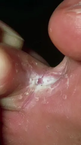 Athlete's foot #healthwise #health #fyp #kihuga 
