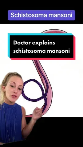 🌍 Raise Awareness: Schistosoma mansoni 🦠💧 Did you know that Schistosoma mansoni is one of the parasites causing the neglected tropical disease known as schistosomiasis? This disease affects millions worldwide, particularly in areas with poor sanitation and limited access to clean water. 🔬 Schistosoma mansoni: The Culprit Schistosoma mansoni is a type of blood fluke that infects humans through contact with contaminated freshwater. The parasite has a complex life cycle, with freshwater snails acting as intermediate hosts. When the larvae released by the snails penetrate our skin while in contact with contaminated water, the infection takes hold. 🤒 The Impact on Health Schistosoma mansoni infection can lead to various health problems. The adult worms reside in the blood vessels of the intestines, causing inflammation, tissue damage, and even fibrosis. Symptoms include abdominal pain, diarrhea, and blood in the stool. Long-term consequences may include anemia, malnutrition, and impaired growth and development in children. 🌍 Join the Fight! Let's raise awareness about schistosomiasis and the impact of Schistosoma mansoni. Together, we can make a difference! ✅ Educate Yourself: Learn more about this parasitic infection, its symptoms, and prevention strategies. Share reliable information with your friends and family. ✅ Promote Hygiene: Encourage clean water practices, such as proper sanitation and safe water sources, to prevent the spread of Schistosoma mansoni and other waterborne diseases. ✅ Support Global Efforts: Contribute to organizations working tirelessly to combat schistosomiasis through prevention programs, research, and treatment initiatives. 💙 Let's stand united against Schistosoma mansoni and help create a world free from the burden of this preventable disease. Spread the word, share the knowledge, and be part of the solution! 💪💙 #SchistosomaMansoni #SchistosomiasisAwareness #WaterborneDiseases #GlobalHealth 