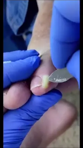 #fyyyyyyyyyyyyyyyy #satisfatorio #viral #pimple #asmr #fly 