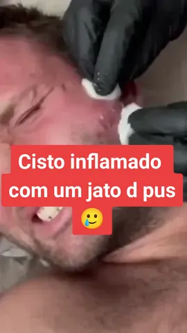 #videossatisfatorios #videosrelaxantes # #tiktok #fypシ #acneremoval #acnefighter #acneskin #acnetiktokindiatreatment #acnetips #acne #videoscuriosos #cistosebaceo #10k #espinhas #espinhasgigantes #espinhasecravos #espinhasnorosto #espinhaschek #espinhasnacara #cravos #cravoseespinhas #cravosgigantes #cravosdeorelha #cravosantigos #cravoslovers #cravosespinhas #viral #tiktok #tiktokindia #dermatologistasbd#foryou #foryopage #cisto #cistosebaceo 