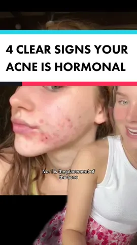4 clesr signs your acne is hormonal - we can all get clear skin!! #breakout #hormonalacne #pcosacne #acne #cysticacne #adultacne #teenageacne 
