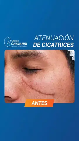 Reduce y homogeniza las cicatrices en un menor tiempo y con una rápida recuperación. 🤩😃 Clínica Chávarri te ofrece el tratamiento CO2 Chávarri que te ayudará a reducir  y homogenizar las cicatrices presentes en la zona afectada, brindando un aspecto de uniformidad y consistencia.👨‍⚕️👩‍⚕️ ⭐ El 60% de nuestros pacientes solo requieren de 01 sesión. 📍 Sede Miraflores : +51 963 765 287 (https://bit.ly/3vIFXw3) 📍Tacna - Av. Billinghurst 170 - l 📲Sede de Tacna +51 972 052 541 (bit.ly/3IsAQne) ⁣ O llámanos: ⁣⁣⁣ 📞01 321 2394⁣⁣⁣ #cicatrices #manchas #rostro #piel