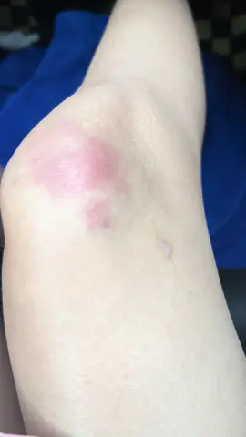 เดินตกจากเตียงอย่างหนักบวมช้ำขึ้นเลื่อยๆเข้าสู่วันที่3ปวดจนไข้ขึ้น🥲งอแงกับใครได้บ้าง😢🥲