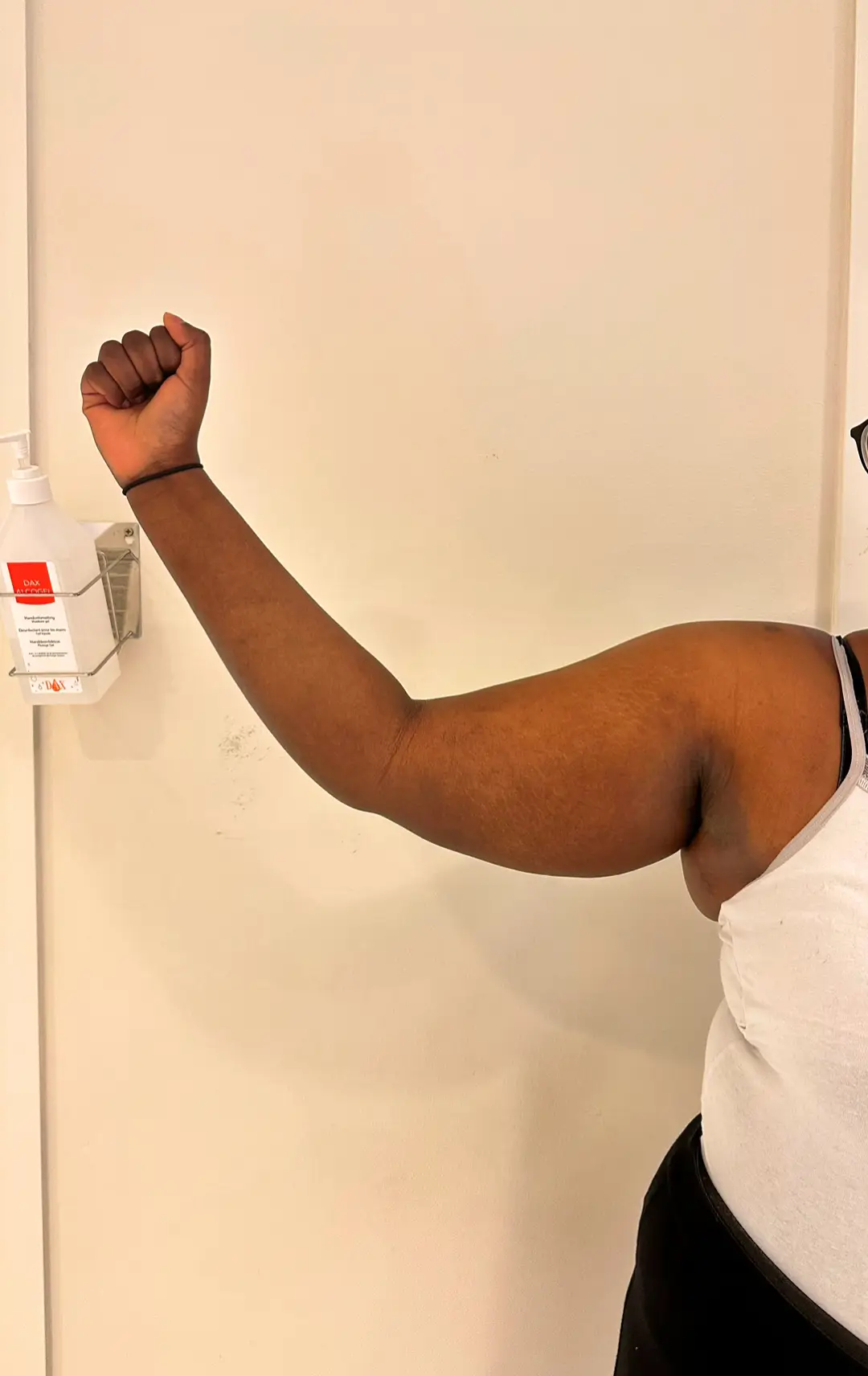 Lipolaser armen! • • Genezen resultaat na  2 maanden! Uitvoerend arts: Drs M Kalmet Kosten : €1750 permanent resultaat. Wij voeren deze behandeling alleen uit in locatie Roermond op dinsdag, woensdag en sommige zaterdagen. #necklift #lipolaser #lipo #laser #doublechin #doublechinremoval #onderkinverwijderen #onderkin #privatemediclinic #armlipo #armliposuction