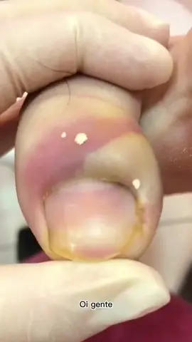 Exploding the bubble! 👣 #ingrowntoenail #ingrownnail #ingrown #ingrowntoenailremoval #footpain #fyp #ingrowntoenailsurgery #stubborn #granuloma  #satisfying #relaxing #viralvideo @FootWorks Relaxing 