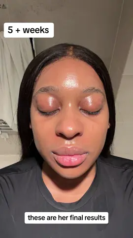 Our sivalskin client ! What an amazing journey. Products used: Hyperbright face wash and cream  Vitamin glow serum Ultra acne cream  #acne #hyperpigmentation #tretinoin #retinol #retinal #vitmainc #sivalskin #skincare #fyp #beforeandafter #pcos