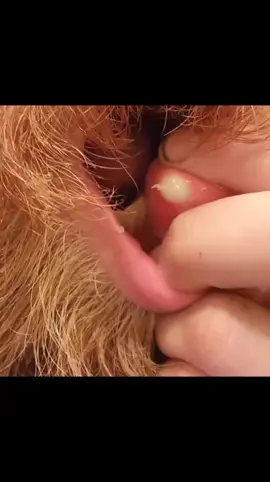 SHEESH! #dr_pimple_popper_top❤️