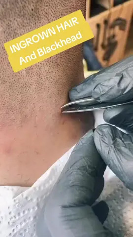 #blackhead #pimple #pimplepoppersatisfying 