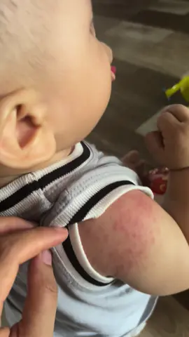 Bé bị rôm sảy làm sao hết cả nhà #conyeu #giadinhtieuho 