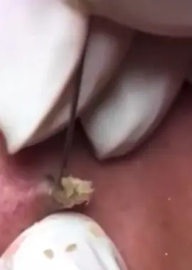 #extractions #blackhead #onnose #hugepimple #satisfying 