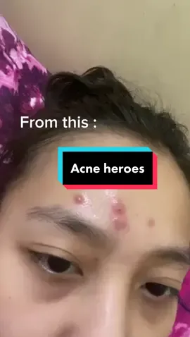 Muka bebas dari jerawat memang auto jadi pede 😍 ya gak sih? 🤭 untung sudah ketemu my #acneheroes La Tulipe Acne series #latulipecosmetiques #fightyouracne #bebasjerawat 