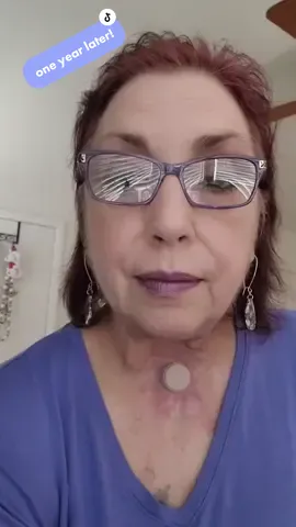 #laryngecomy #stage4throatcancer #stage4throatcancersurvivor #neckbreather  #voiceboxremoved #holeinmyneck #tep #tracheosophagealvoiceprothesis #mimi #mom #gastricsleeve #femalearmyveteran #purple 💜