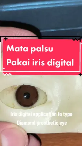 Penggunaan iris digital 3D Knoch, pada protesa mata type Diamond. Proses pembuatan secara digital tanpa dilukis manual, sehingga proses lebih cepat dan warna yang lebih akurat, sesuai dengan warna mata asli. #matapalsu #protesamata #prostheticeye #eye #3dprintingIndonesia #okularis #ocularprosthesis #revolusiindustri4 #ocularist #matabuatan #eyeprosthesis #3dscan 