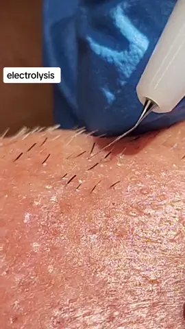 #permanenthairremoval #juicyroots #electrolysis #electrolysishairremoval #pco#progess #selflove #allgenderswelcome #allgenders #allgendershavehair #lgbtq #pcosawareness #pcos #pcodproblems #pcosweightloss 