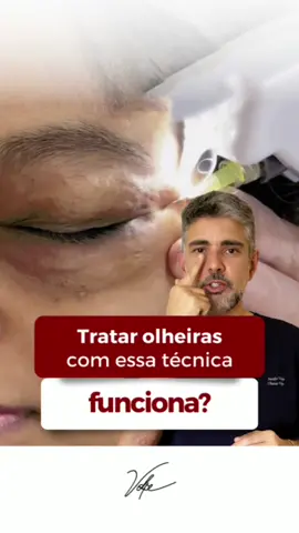 Qual técnica para tratar olheiras é essa? 👀 Essa é a #Carboxiterapia, tratamento que funciona aumentando a circulação local e com isso, age no aspecto das #olheiras, nesse vídeo explico mais detalhes. Nele também revelo um tratamento duradouro e eficaz que utilizo para corrigir essa região. Gostou do conteúdo? #olheiras #olhos #rugas #bolsas  #colageno  #dermatologia #estetica #dermatologist #doctorderm #pele #skincare 