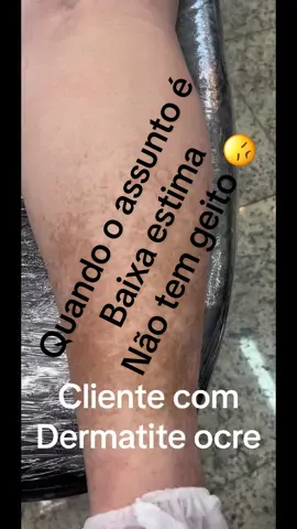 Minha cliente com Dermatite ocre! Ela tava com muita baixa estima devido essas manchas na pele,ela me procurou e saiu muito feliz com resultado #tiktok #viral #pele #dermatologist 
