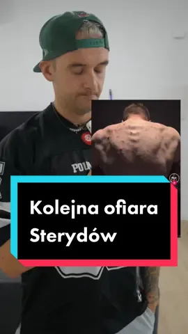 Kolejny pokaz idiotyzmu i tego czym sie konczy robienie cyklu na towarze nieznanego pochodzenia, bez badan i bez opieki specjalisty. Bacne to forma tradziku po sterydowego (acne vulgaris) ktory jest bardzo ciezki do wyleczenia a skuteczne leczenie moze trwac nawet kilka do kilkunastu miesiecy #medycyna #zdrowie #dieta #dietetyka #trening #sterydy #hormony #cykl #sarmy #tradzik #dermatologia #odzywianie #zywienie #odchudzanie #edukacja #mitydietetyczne #jakschudnac #suplementydiety 