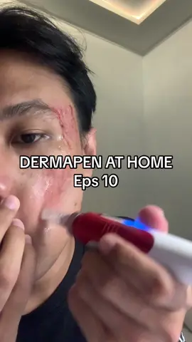 Dermapen sendiri dirumah lagi ke #10  #dermapen #prptreatment #bopeng #laserfractional #acnefighter 