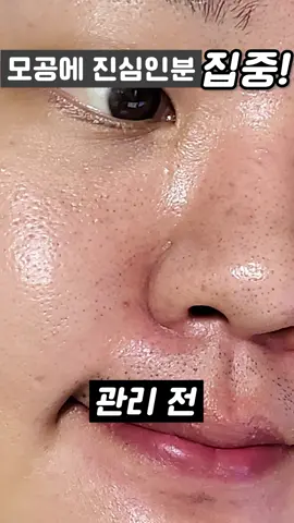 🤷‍♀️모공쟁이들 집중! 직접 효과본 올리브영 모공 꿀템 BEST3 #올리브영추천템 #올리브영추천 #모공관리 #모공관리템 #모공관리법 #모공패드 #모공클렌징 #모공크림