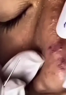 #extractions #removals #satisfying #pimple #bigblackhead #onnose 