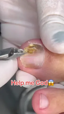 #podologia #satisfying #podocure #fypシ #ingrowntoenail 