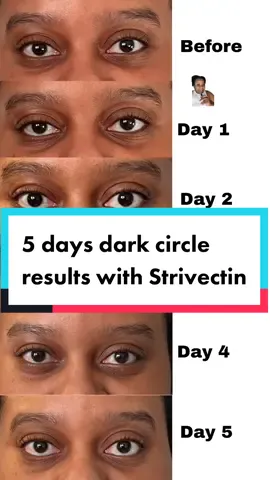 This has been in my drafts for a while, so I decided to post it! Product was received as part of a project with @StriVectin #greenscreen #strivectineyecream #darkcircles #undereyecircleshack #eyecreamresults 