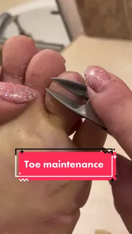 Toe clipping that I forgot to share! #parmeseanpalms #callousremoval #footcallusremoval #parmesanpalms #callousedfoot #footcallus #podologia #podiatry #footcalluses #callusedfoot #dermatology #dermatologist #toes 