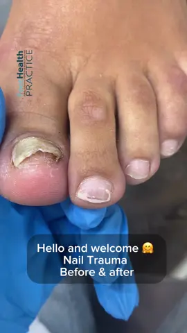 Nail Trauma. Before and after #nailtrauma #medicalpedicure #fungalnail #pedicurevideo #nailbeforenafter 