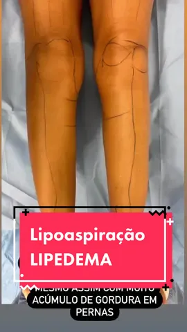 Lipoaspiracao de lipedema estagio 2.  #lipo #lipoaspiração #lipopanturrilhas #lipodepernas #lipolipedema #dicaslipedema #tratamentolipedema #cirugiaplastica #pernasgrossas #pernasdefinidas #pernasgrossas #pernagorda #lipedemabrasil #lipedemaawarenes 