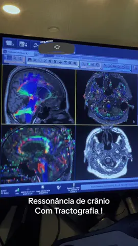 #tractografia #ressonanciamagnetica #viral_video #medicinaestetica 