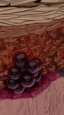 Melanoma Stage 2: Cancer cells divide and tumor grows #Science #cancer  #biology  #medicalanimation #molecularbiology  #maya #vray #aftereffects #3danimation #3d