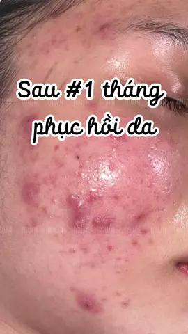 Phục hồi da mụn viêm kích ứng #trimun #nanmun #chamsocda #musacliniqueroom #GocLamDep #spahanoi 
